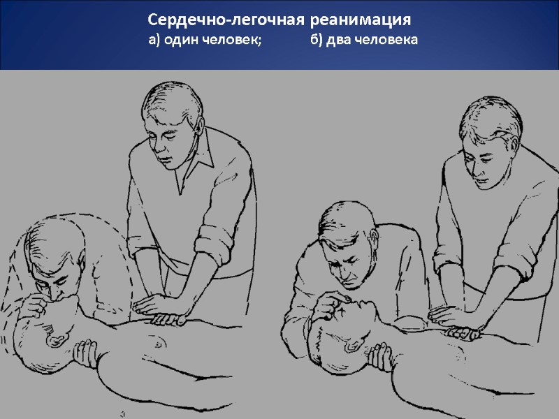 Сердечно-легочная реанимация   а) один человек;       